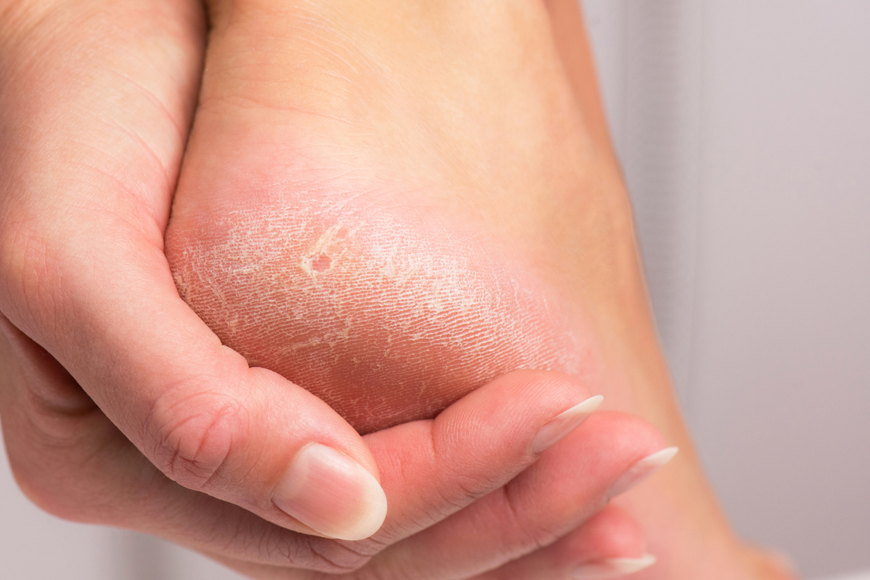 Dry skin on the feet cracks. | Stock Video | Pond5
